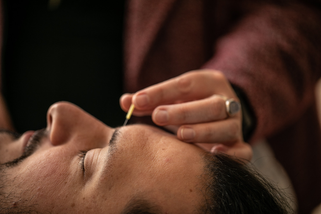 Relaxed man smiling as he receives acupuncture